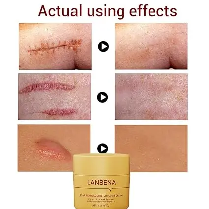 Picture of LANBENA Scar Remover Cream Repair Serum Stretch Mark Blackhead Acne Spots TCM Removal Gel Whitening Face Body Essence-40GM