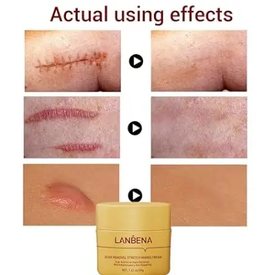 Picture of LANBENA Scar Remover Cream Repair Serum Stretch Mark Blackhead Acne Spots TCM Removal Gel Whitening Face Body Essence-40GM