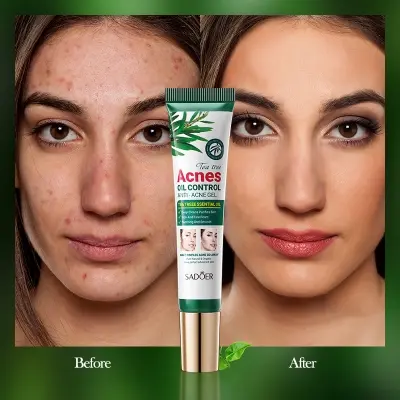Picture of SADOER Tea Tree Acne Oil Control Face Gel Anti-Acne Gel 20g