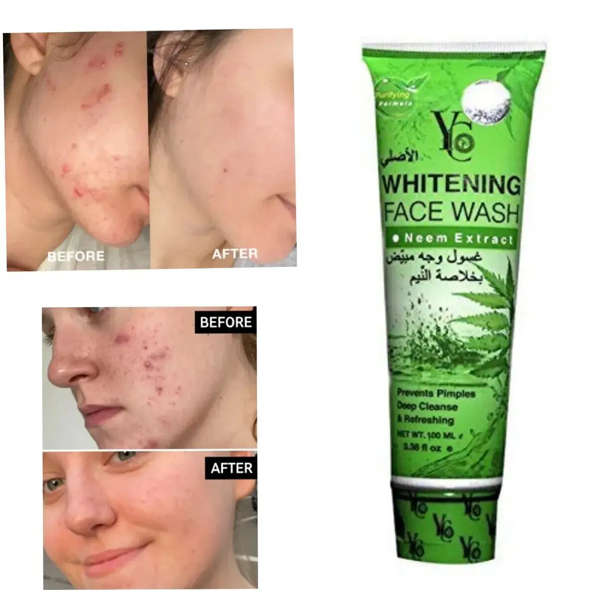 Picture of YC Whitening Neem Extract Acne Face Wash for Unisex - Prevent Pimples deep cleanse & Refreshing (100 ML)
