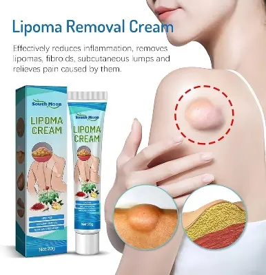 Picture of South Moon Lipoma Removal Cream Lipolysis Fat Lump Relieve Plaster Skin Swelling Ointment Subcutaneous Lumps Dredge Dissipate Body Care（20g）