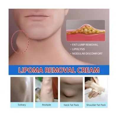 Picture of South Moon Lipoma Removal Cream Lipolysis Fat Lump Relieve Plaster Skin Swelling Ointment Subcutaneous Lumps Dredge Dissipate Body Care（20g）