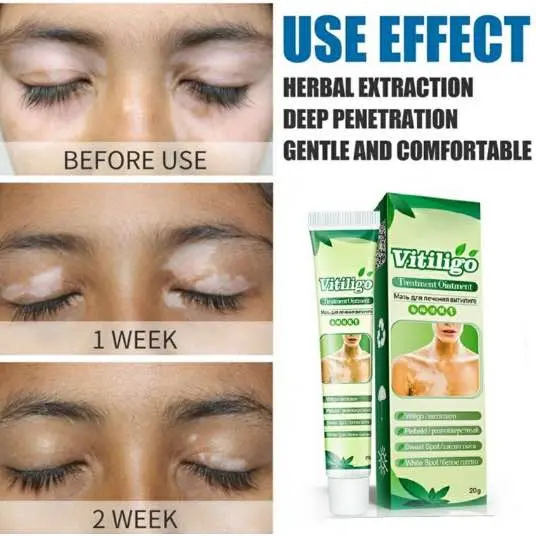 Picture of Sumifun Vitiligo Cream Reduces White Spots and Improves Skin Pigmentation-20gm