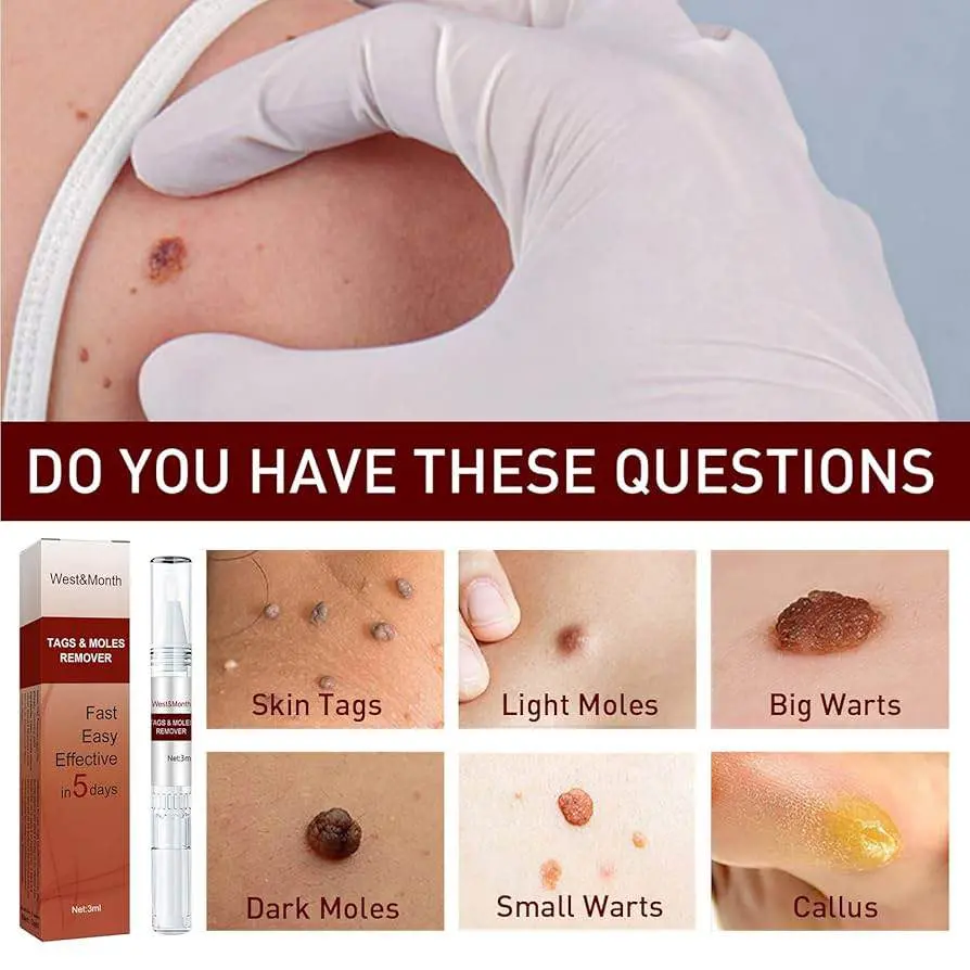 Picture of Moles Remover Pen West Month Tags 3 Ml