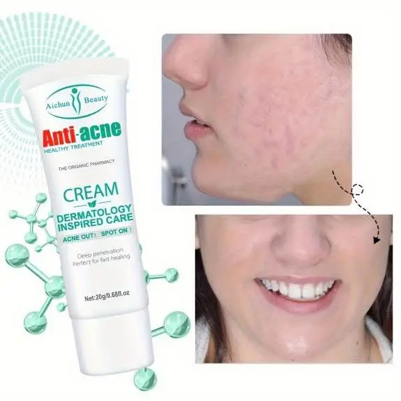Picture of AICHUN BEAUTY Anti-Acne Cream Treats Pimple Clogged Pores Oil Control Reduces Acne Scars Shrinks Pores 20g
