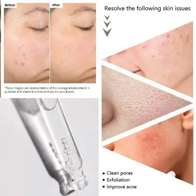 Picture of Salicylic Acid 2% Solution 30ml 