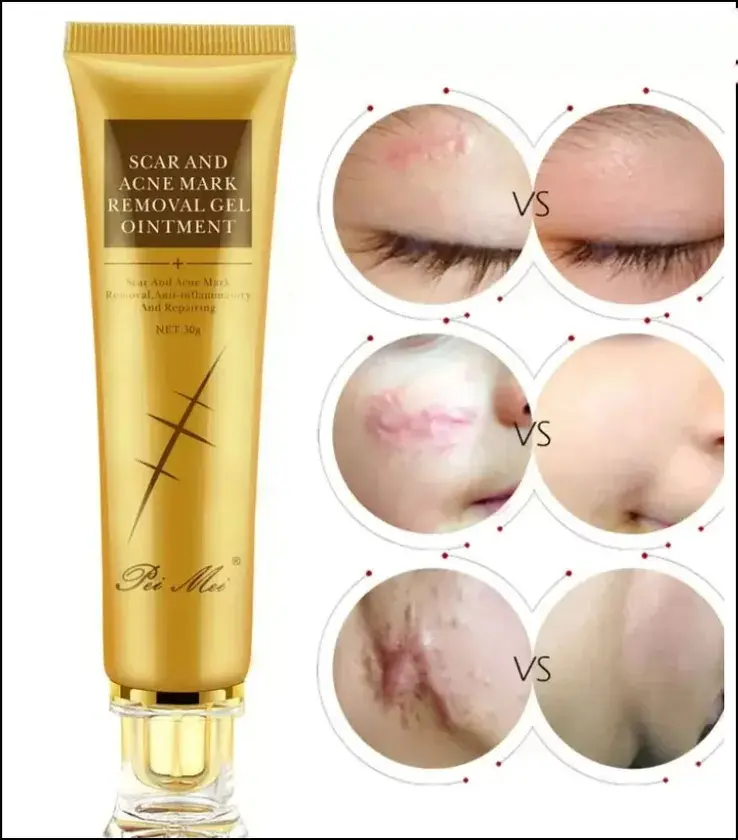 Picture of Pei Mei Scar And Acne Mark Removal Gel Ointment 30 G 