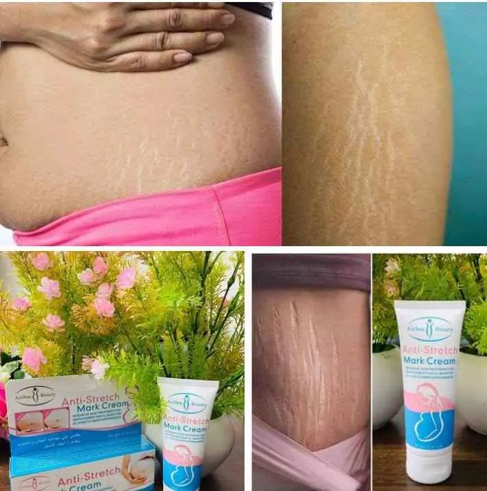 Picture of Aichun Beauty Anti-Stretch Marks Cream | Stretch Marks Removal Cream new