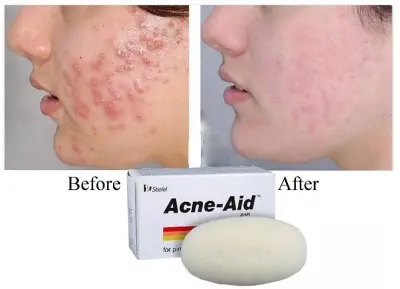Picture of Stiefel Acne-Aid Exfoliating Body Soap Bar for Pimple-Prone/Oily Skin 100g(Fresh)