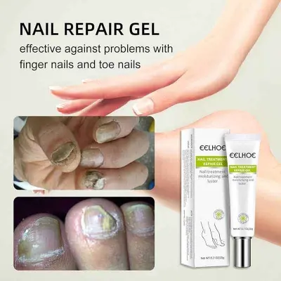 Picture of EELHOE Nail Fungus Repair Essence Gel Nail Treatment Repair Cream Gel-20gm NEW