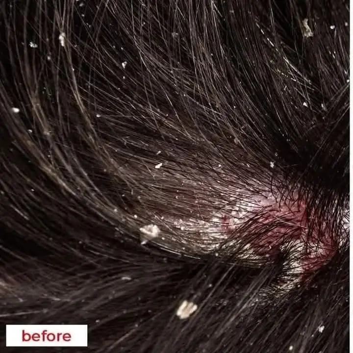 Picture of Nizoral 2% Ketoconazole Hair Care Anti-Dandruff Shampoo 100ml - Multicolor