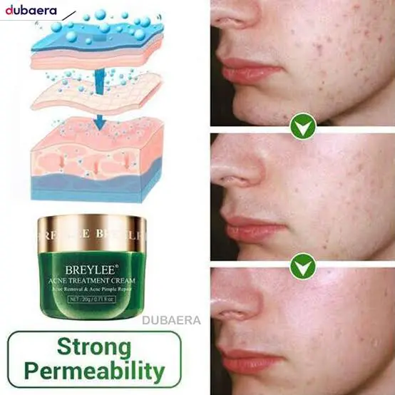 Picture of Breylee Acne Treatment Cream for Skin Care 20 Gms