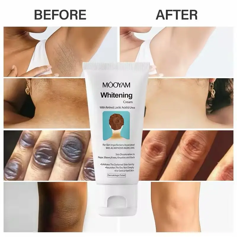 Picture of Skin Mooyam Whitening Cream Acanthosis Nigricans Remove Black Patches Dark Spot Corrector Knee Elbow Underarm Neck Lightening Cream