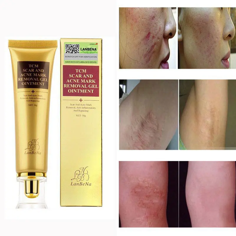 Picture of LANBENA TCM scar and Acne Spot Removal Gel Ointment