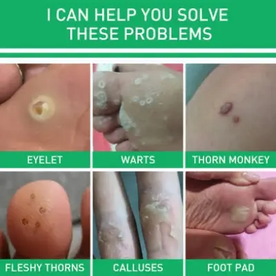 Picture of Jaysuing Active Corn Remover Gel – 10ml Strong Formula for Effective Callus and Corn Removal