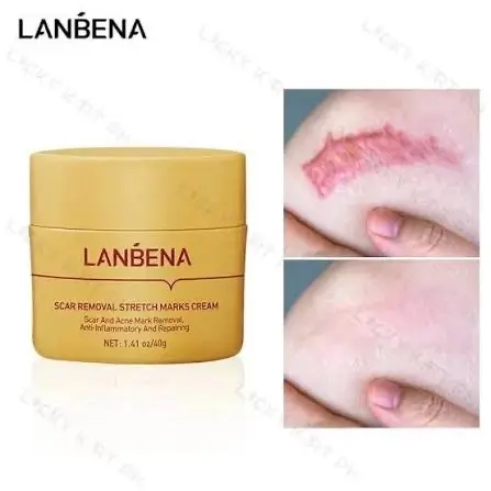 Picture of LANBENA Acne Scar Removal Cream Repair Acne Spots Acne Treatment Blackhead Whitening Shrink Pores Stretch Marks Skin Care 40g