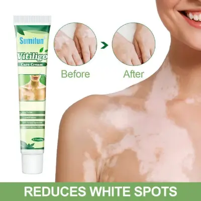 Picture of Sumifun Vitiligo Cream Reduces White Spots and Improves Skin Pigmentation