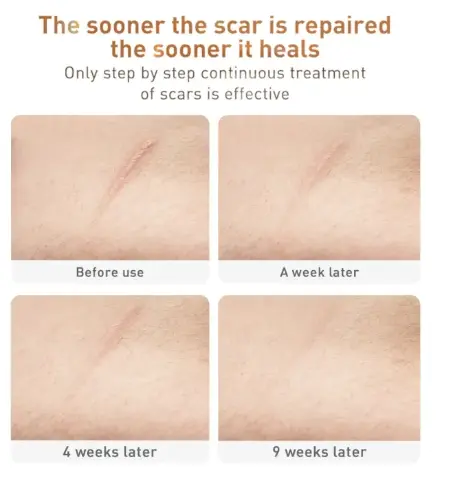 Picture of Lanbena Tcm Scar And Acne Removal Gel Ointment 30G 