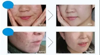 Picture of BIOAQUA Pure Skin Acne Rejuvenation & Cream - 30g 