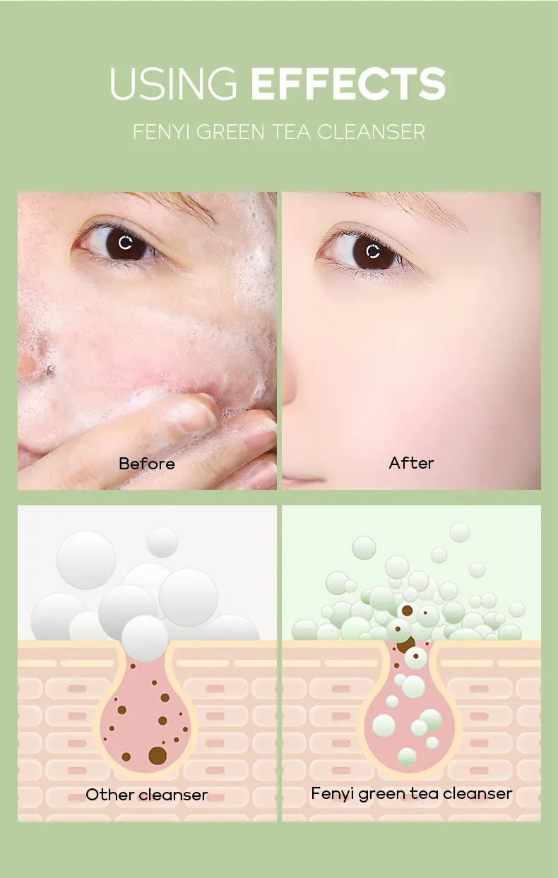 Picture of Fenyi Tea Tree Acne Removal Face Toner Repairing Soothing Tighten Pores - 100ml 