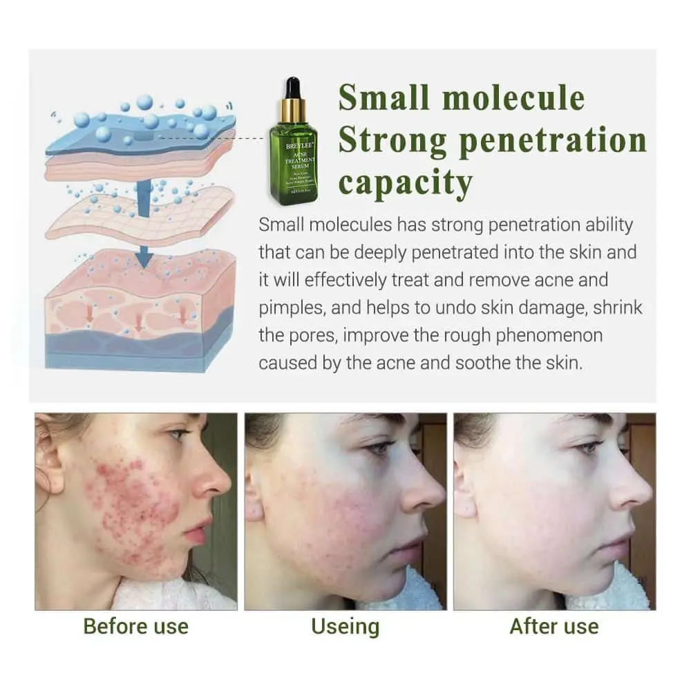 Picture of Breylee Acne Treatment Serum 17ml 