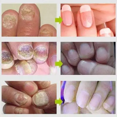 Picture of Efero Nail Repair Treatment Gel Fungus Cream-20gm (Next lavel cosmic)