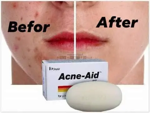 Picture of Stiefel Acne-Aid Bar 100g Pimple Prone & Oily Skin Acne Aid Soap