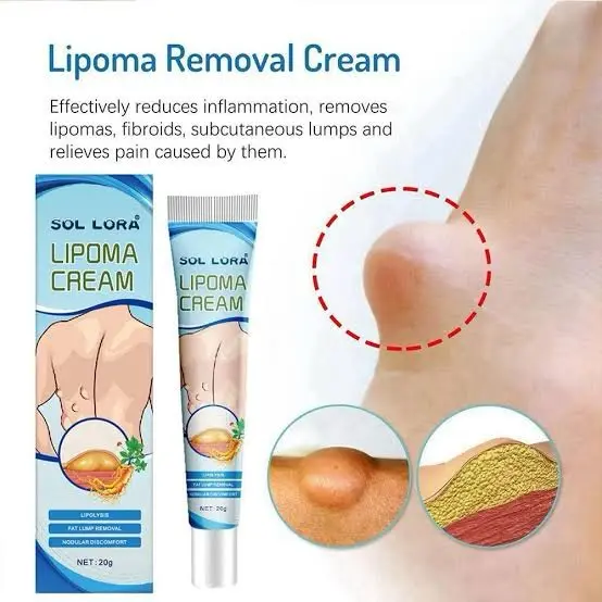 Picture of South Moon Lipoma Removal Cream Lipolysis Fat Lump Relieve Plaster Skin Swelling Ointment Subcutaneous Lumps Dredge Dissipate Body Care（20g）