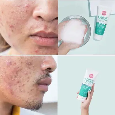Picture of Cathy Doll Acne Oil Control Cleansing Foam Paraban Free - 150 ml (Thailand)
