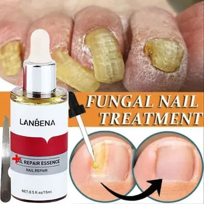 Picture of LANBENA Nail Repair Essence Serum Fungus Treatment Nail Removal Onychomycosis-15ml