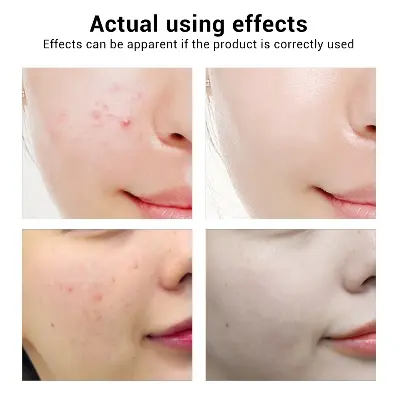 Picture of Tea Tree Acne treatment Serum- 17ml