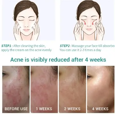 Picture of LAIKOU Oil Control Moisturizing Acne Removal Gel- 20g