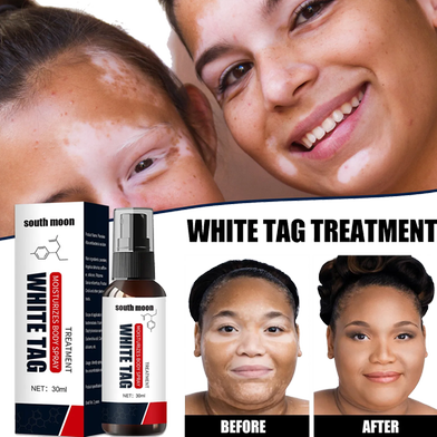 Picture of South Moon White Tag Treatment Vitiligo Therapeutic Serum Universal White Spot Cleansing Spray -30ml