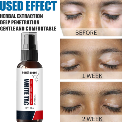 Picture of South Moon White Tag Treatment Vitiligo Therapeutic Serum Universal White Spot Cleansing Spray -30ml