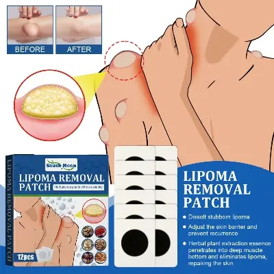 Picture of South Moon Lipoma Removal Cream Lipolysis Fat Lump Relieve Plaster Skin Swelling Ointment Subcutaneous Lumps Dredge Dissipate Body Care（20g）