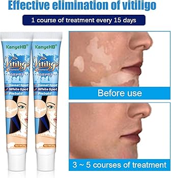 Picture of Eliminate Vitiligo Skin Care Leukoplakia Cream Herbal Extract White Spot Removal Skin Reduce Melanin