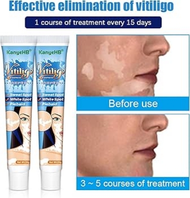 Picture of Eliminate Vitiligo Skin Care Leukoplakia Cream Herbal Extract White Spot Removal Skin Reduce Melanin