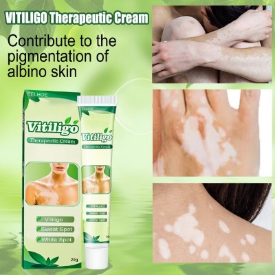 Picture of Vitiligo Treatment Cream Healthy White Spot Therapeutic Gel
