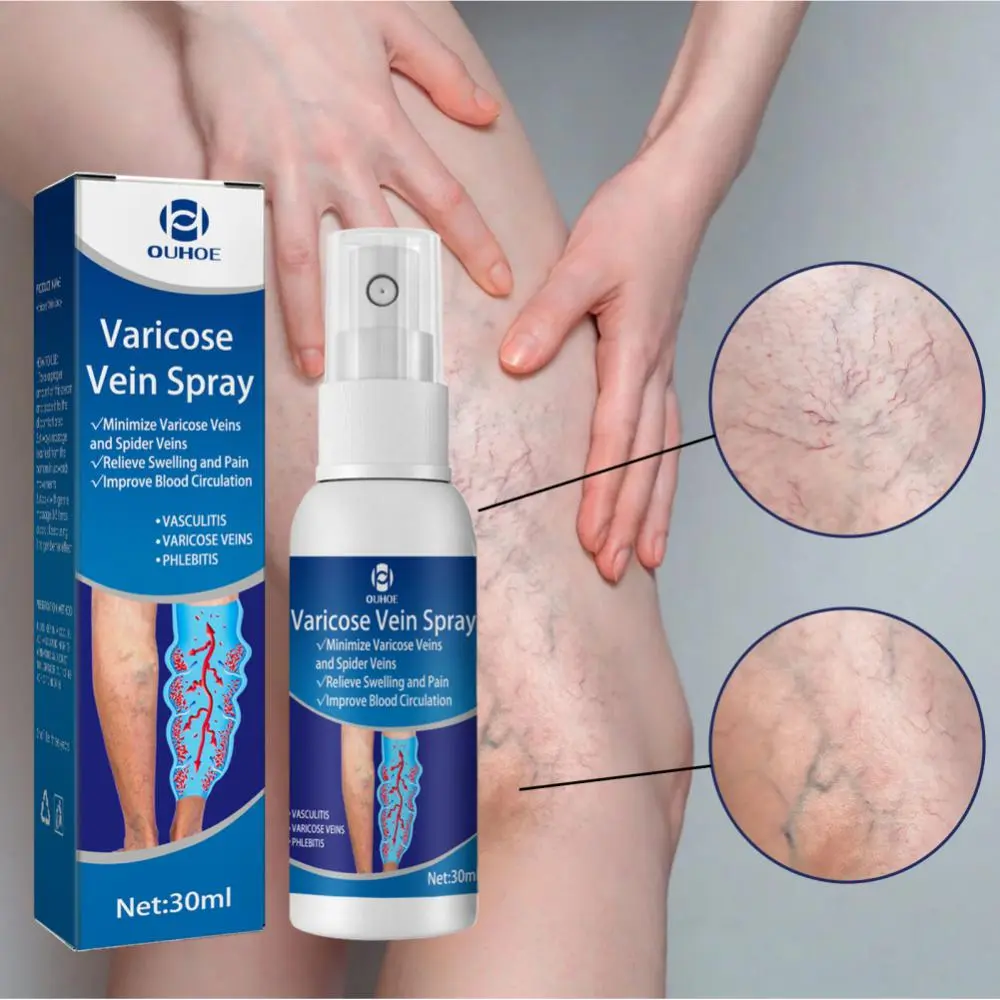 Picture of Varicose Veins Spray Medicine Spider Veins Relief Vasculitis Phlebitis Spider Pain Relief Plaster Care 30ml