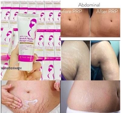 Picture of Pax Moly Mom’s Care Stretch Mark Cream -70ml