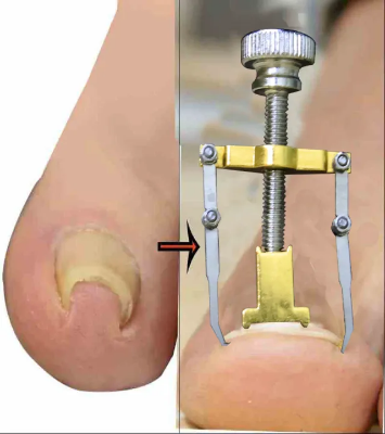Picture of Nail Care machine for nail repair Pedicure Correction Tool Foot Correcting Device Ingrown Toenail Fixer Toe nail Recover-The Asia Express - Gold