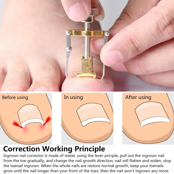 Picture of Nail Care machine for nail repair Pedicure Correction Tool Foot Correcting Device Ingrown Toenail Fixer Toe nail Recover-The Asia Express - Gold