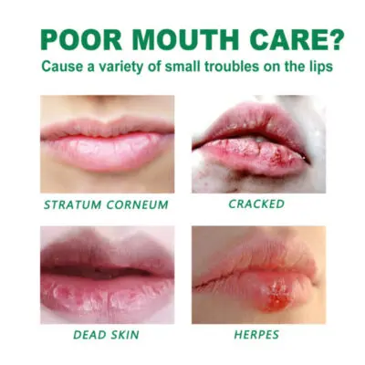 Picture of Herbal Medicated Lip Balm | Best Lip Balm for Dark Lips in Bangladesh- The Asia Express - Multicolor