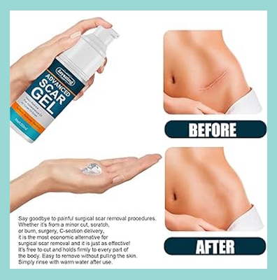 Picture of 50ml Scar Removal Gel - Effective Stretch Mark, Acnes Spots, Burns and Surgical Scars Treatment Cream - Retinol, Allantoin,Vitamin E - Post Surgery Skin Repair Supplies No Side Effects 