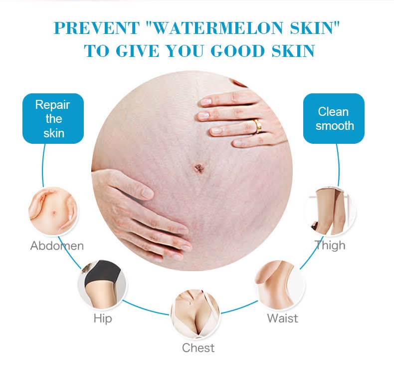 Picture of Aichun Beauty Anti-Stretch Marks Cream | Stretch Marks Removal Cream