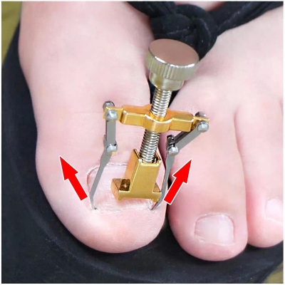 Picture of Recovery Tonel Correction Of New Pro Ingrown Toes Nails Details About Pedicure Fixer Gold 