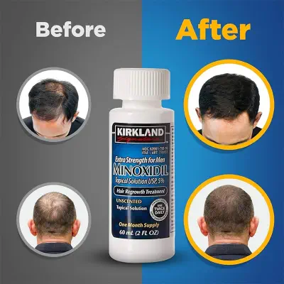 Picture of Kirkland Minoxidil 5% For Beard & Hair Growth (One Month Supply/Six Months Supply) Made in USA - Imported-01 White