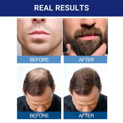 Picture of Kirkland Minoxidil 5% For Beard & Hair Growth (One Month Supply/Six Months Supply) Made in USA - Imported-01 White